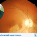 Age-Related Macular Degeneration (AMD) Market