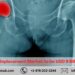 Moving Forward with Hip Replacements: Global Market Projected to Grow to USD 9 Billion by 2028 – Renub Research